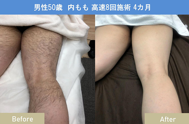 男性50歳 内もも 高速8回施術4ヵ月