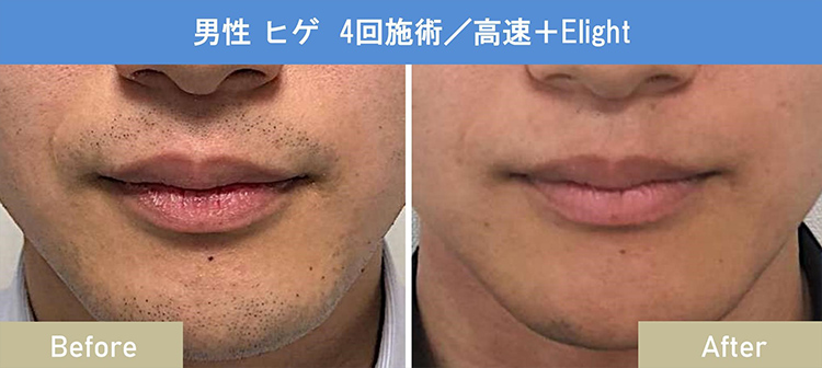 男性 ヒゲ 4回施術/高速+Elight